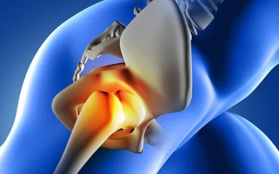 Precision Hip Replacement